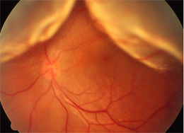 網膜剥離（正面から）
