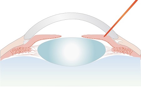閉塞隅角緑内障・原発閉塞隅角症(いわゆる急性緑内障発作も含む)