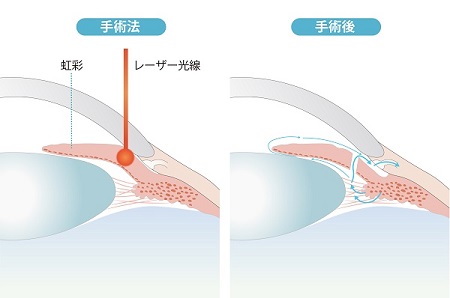 閉塞隅角緑内障・原発閉塞隅角症(いわゆる急性緑内障発作も含む)