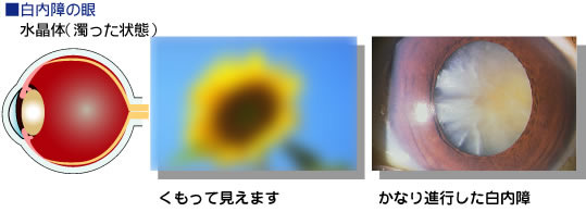 白内障 とは